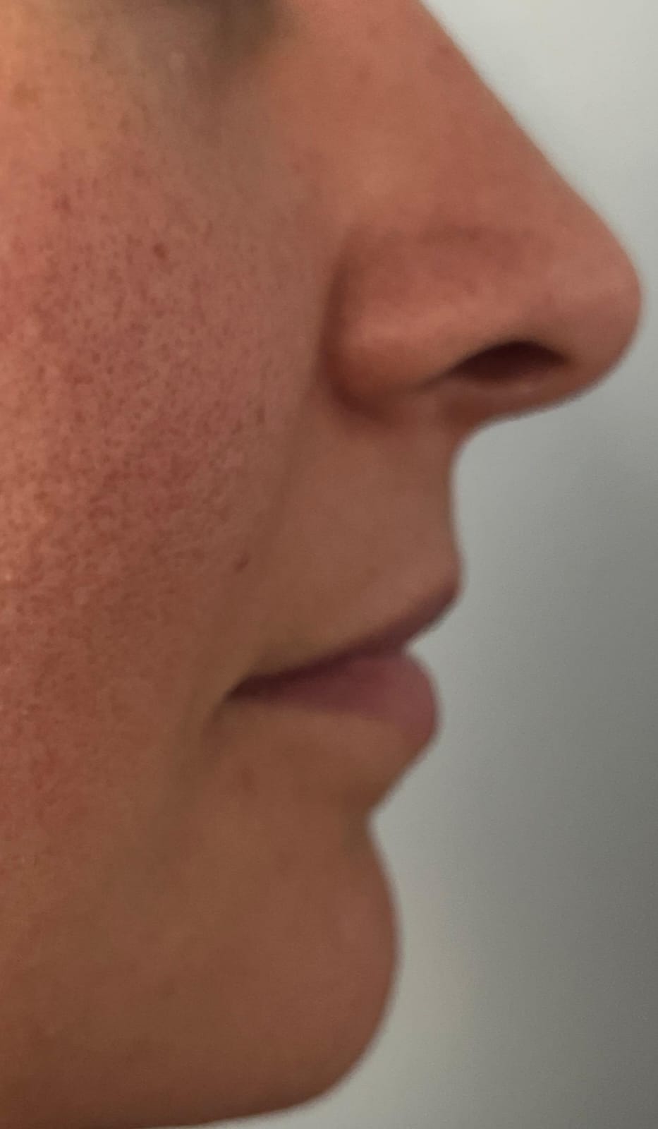 Antes del aumento de labios con ácido hialurónico, caso 1 – NewMe Medicina Estética