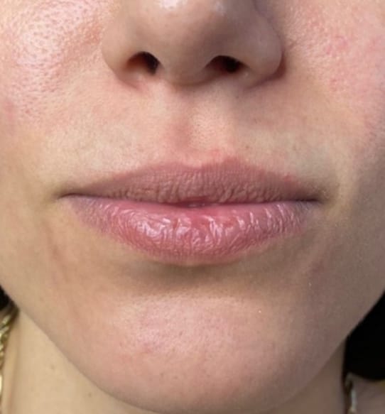 Antes del aumento de labios con ácido hialurónico, caso 2 – NewMe Medicina Estética