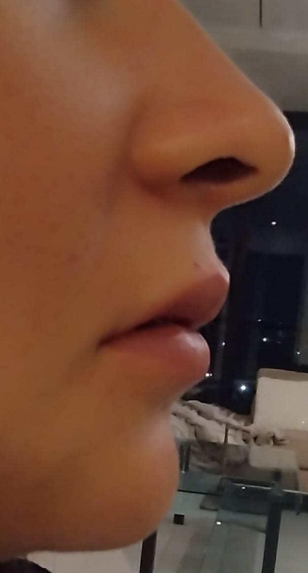 Después del aumento de labios con ácido hialurónico, caso 1 – NewMe Medicina Estética