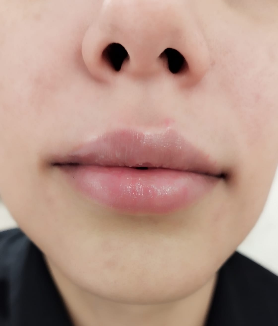 Después del aumento de labios con ácido hialurónico, caso 2 – NewMe Medicina Estética