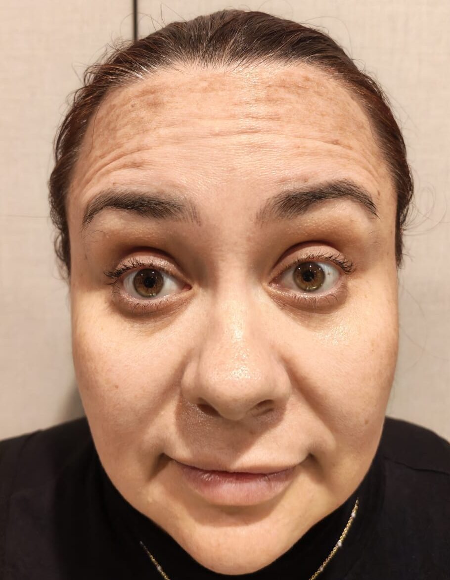 Antes del tratamiento con toxina botulínica en frente y entrecejo, caso 1 – NewMe Medicina Estética