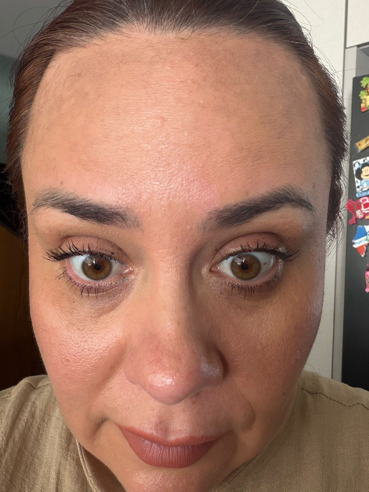 Después del tratamiento con toxina botulínica en frente y entrecejo, caso 1 – NewMe Medicina Estética