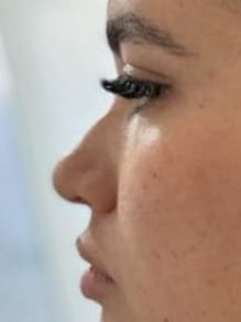 Antes de la rinomodelación no quirúrgica, caso 1 – NewMe Medicina Estética