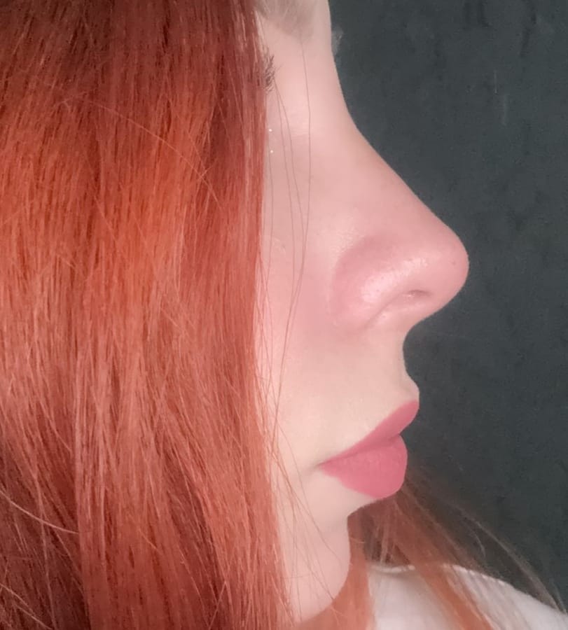 Después de la rinomodelación no quirúrgica, caso 2 – NewMe Medicina Estética